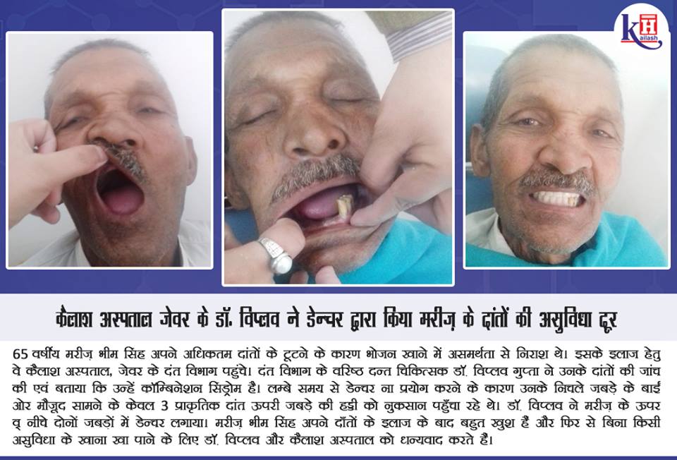 Denture treatment by Kailash hospital Jewar's Sr. Dental Surgeon helps a patient restore his Dental health