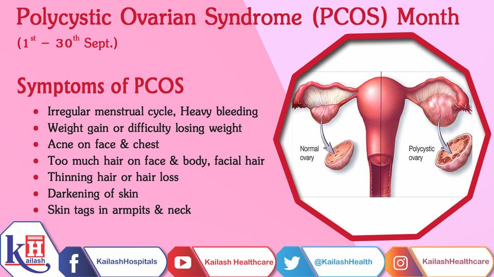 PCOS is a hormonal disorder common among women of reproductive age. Symptoms vary as per their ages while it can be managed well if diagnosed early.