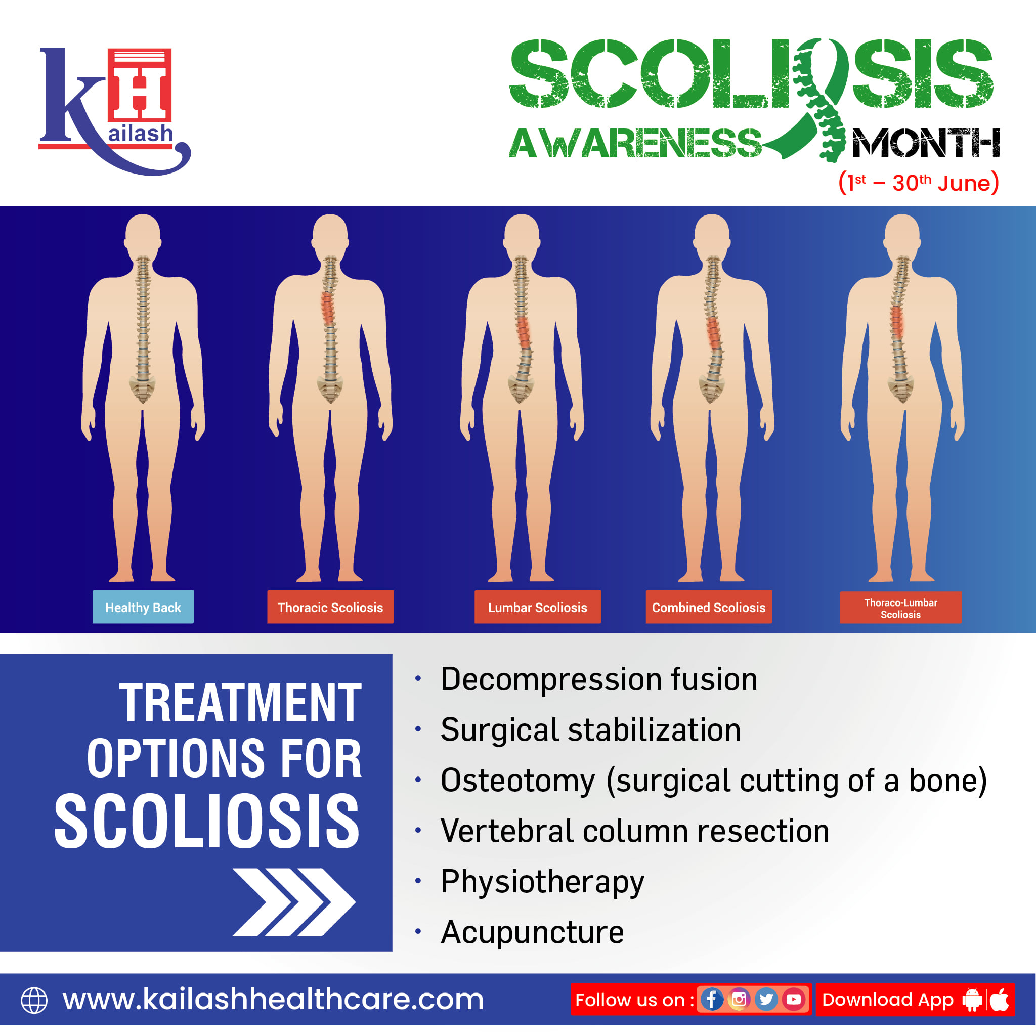 Structural Scoliosis is permanent or a birth defect while Nonstructural Scoliosis describes temporary curves that can be fixed.