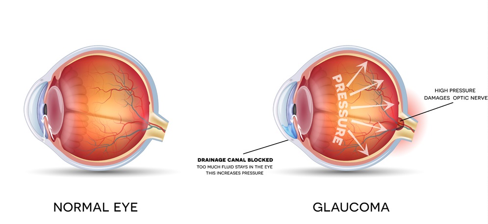Glaucoma, one of the chief causes of Blindness. 