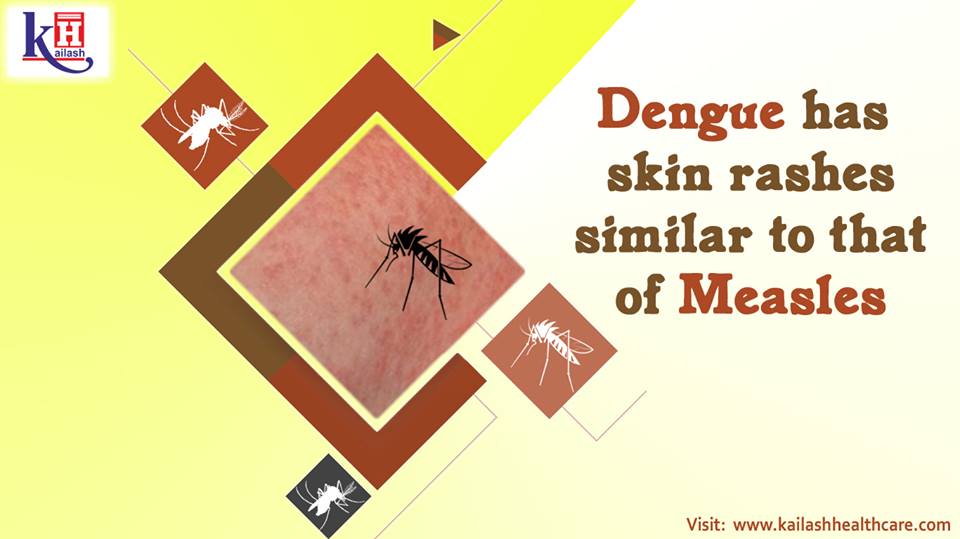 Dengue has skin rashes similar to that of Measles