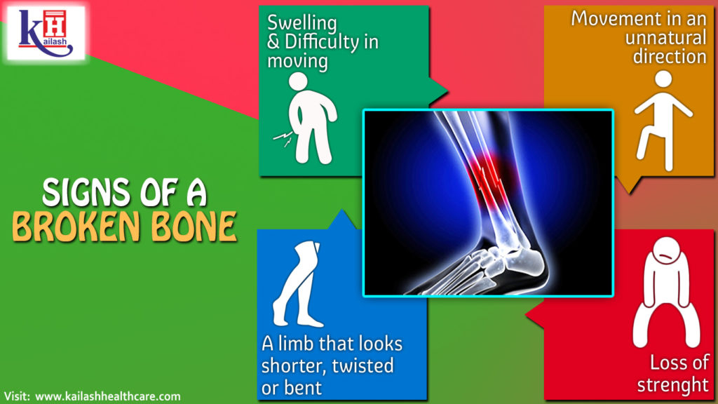 Signs of a Broken Bone