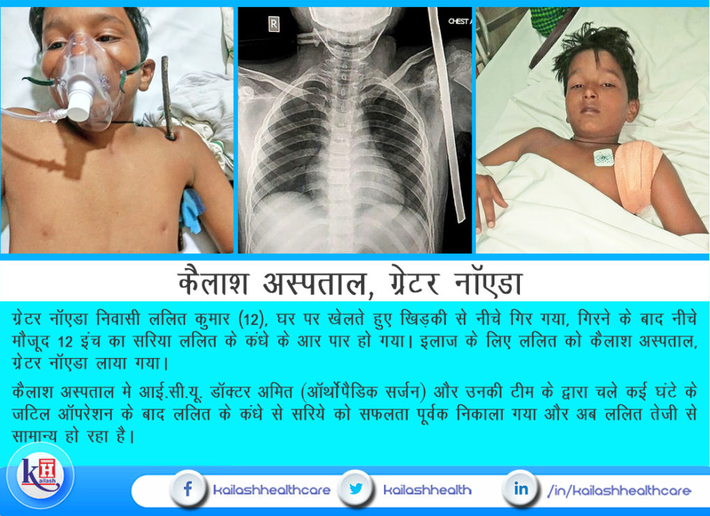 लड़के के कंधे मैं घुसा 12 इंच का सरिया - कैलाश अस्पताल ग्रेटर नॉएडा मे हुआ इलाज