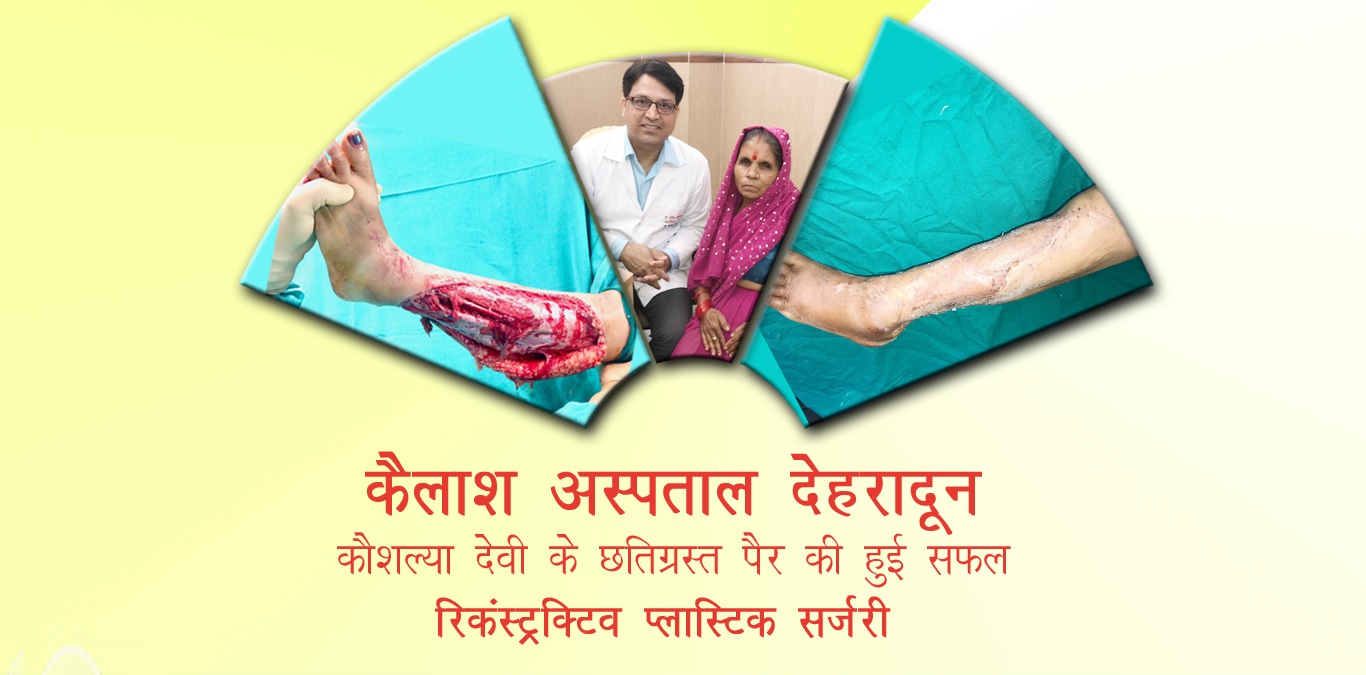 कैलाश अस्पताल देहरादून : कौशल्या देवी के छतिग्रस्त पैर की हुई सफल रिकंस्ट्रक्टिव प्लास्टिक सर्जरी