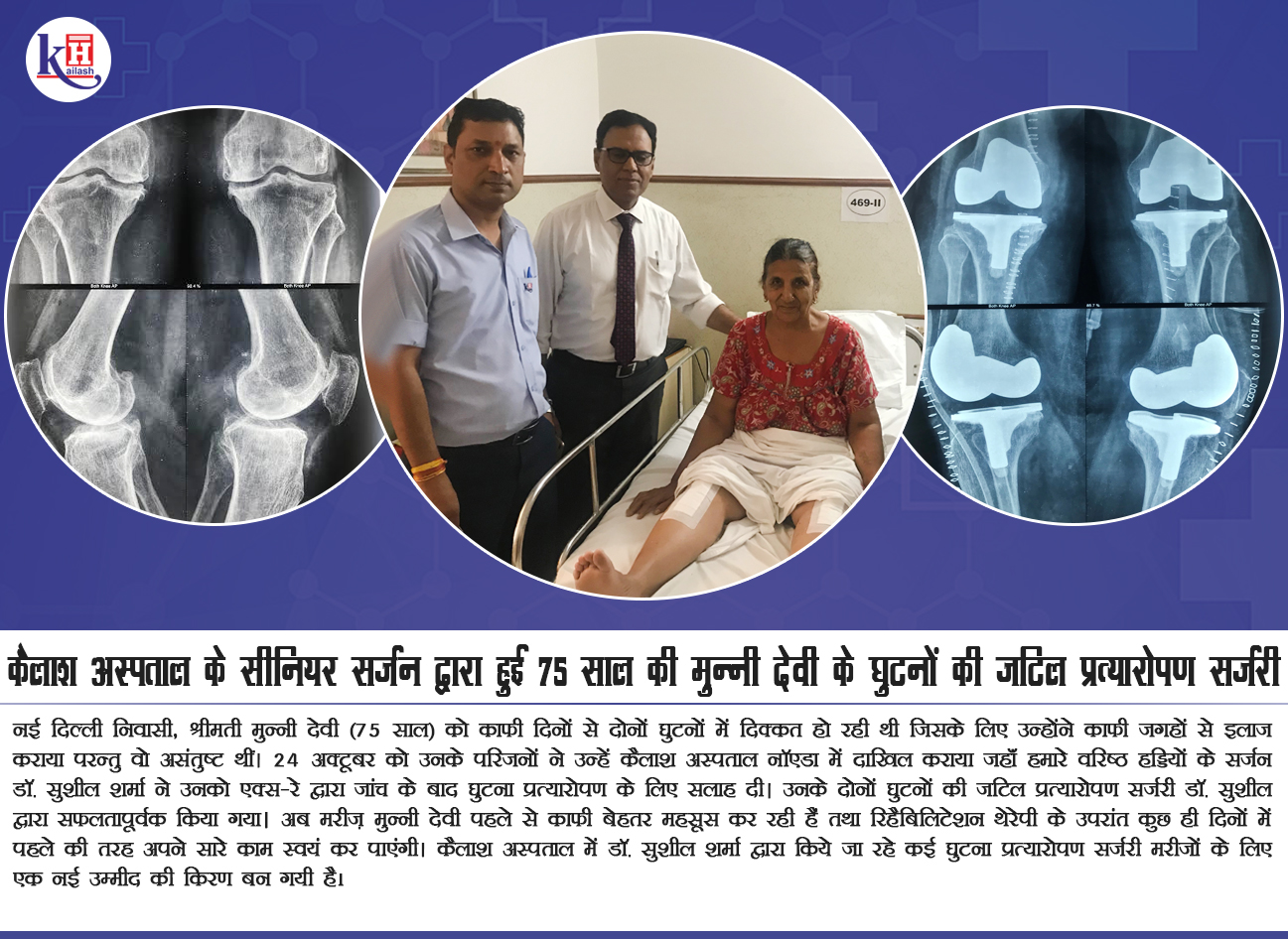 कैलाश अस्पताल के सीनियर सर्जन द्वारा हुई 75 साल की मुन्नी देवी के घुटनों की जटिल प्रत्यारोपण सर्जरी
