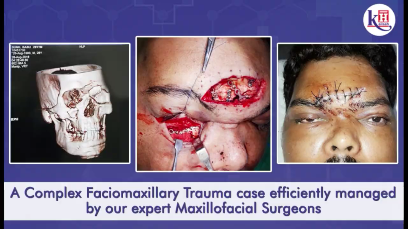 Mr. Gaurav & Mr. Sunil thank Kailash Hospital’s Surgeons for their successful Maxillofacial Surgery