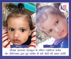 Successful Surgery of patient's Cleft Lips performed by Sr. Plastic Surgeon of Kailash Hospital Dehradun