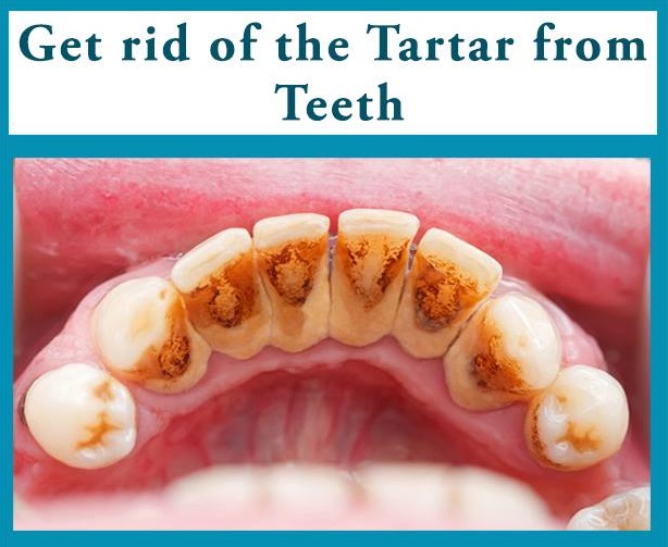 How Can Your Teeth Stay Protected From Plague & Tartar?