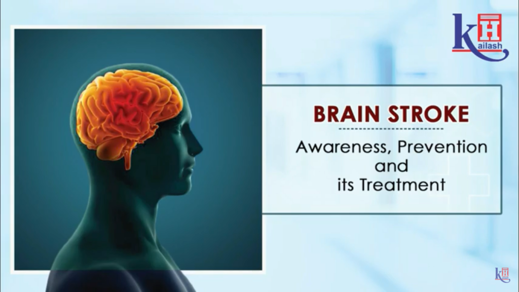 Brain Stroke Awareness, Prevention & Treatment