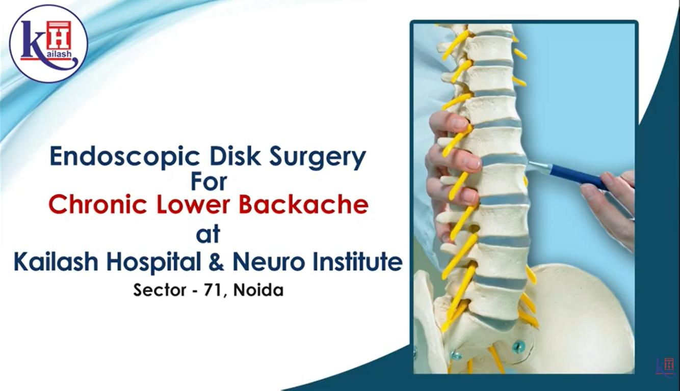 Lower Backache treatment through Endoscopic Disc Surgery | Neurosurgeon Dr. Shrikant Sharma