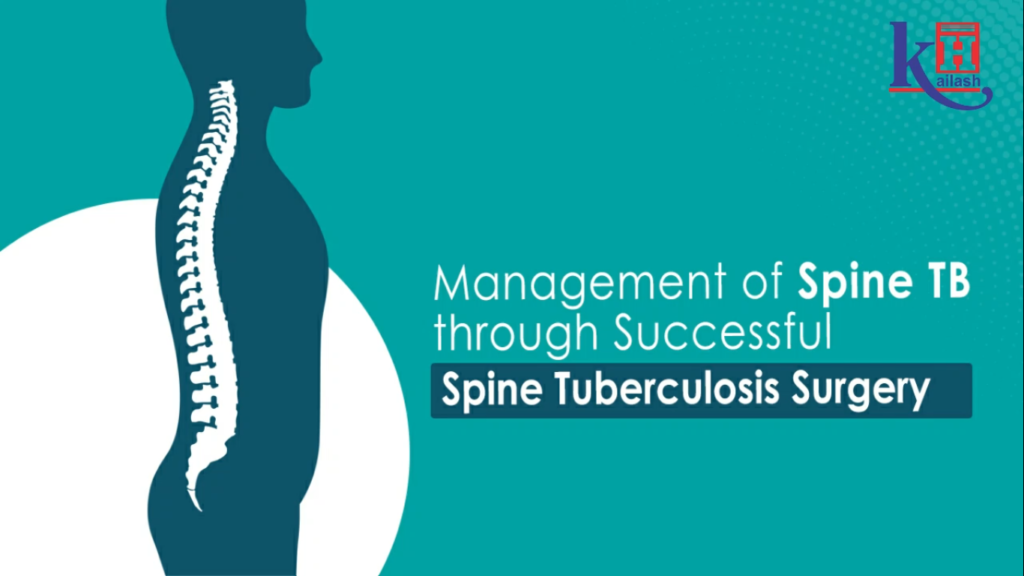 Successful Spinal Tuberculosis Surgery by Dr. Debabrata Mukherjee | Kailash Hospital Sec 27 Noida