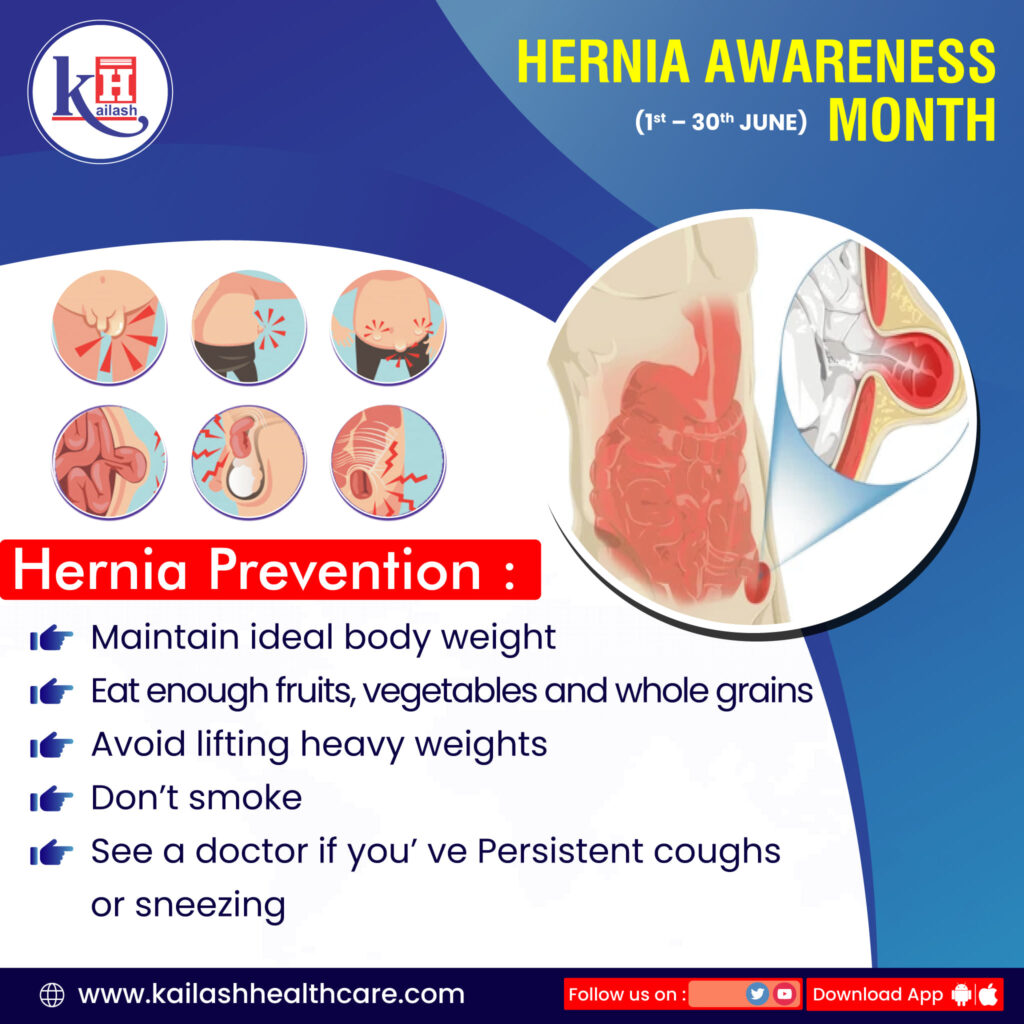 Healthy Lifestyle & Timely care can help prevent Hernia.
